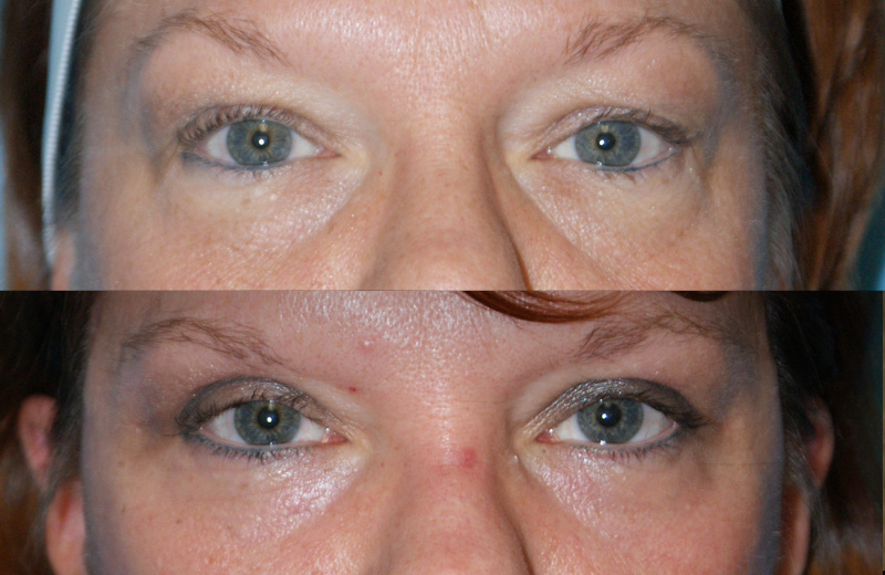 Eyelid Surgery Before & After Pictures Chicago MAE