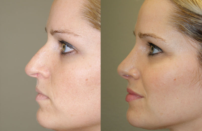 rhinoplasty before and after