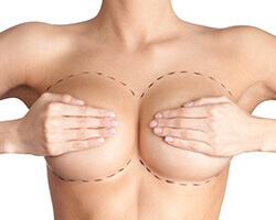 Breast Plastic Surgery Before and After Pictures