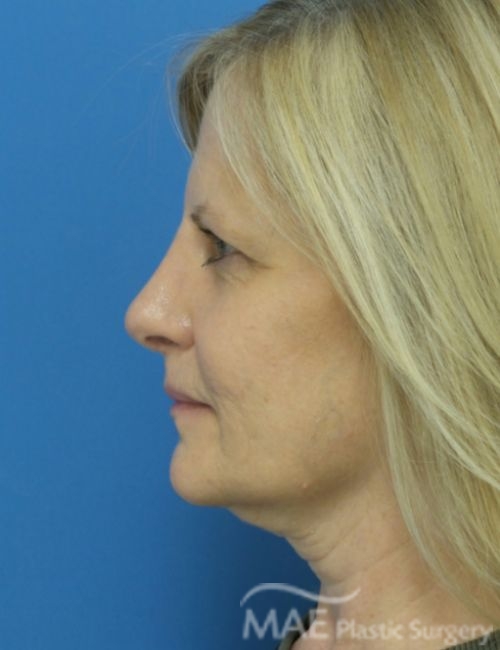 Nostrils Uneven After Rhinoplasty? What to Do MAE Plastic Surgery