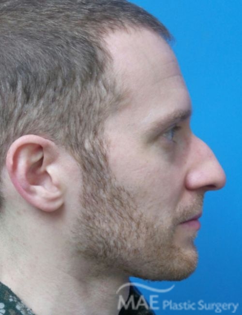 How to Sleep Safely After Rhinoplasty MAE Plastic Surgery