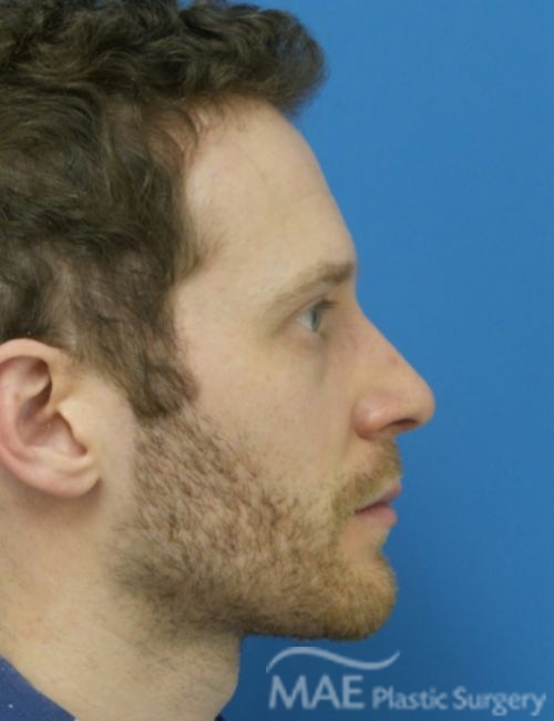 How to Sleep Safely After Rhinoplasty MAE Plastic Surgery